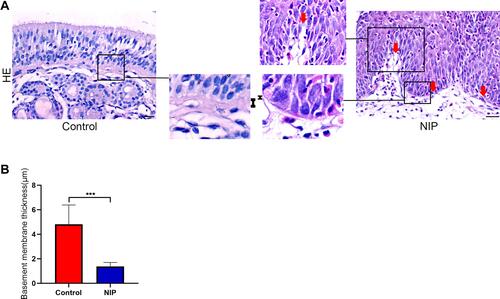 Figure 2 Basement membrane thickness of NIP tissue and healthy control. (A) H&E staining was performed to determine the thickness of NIP and healthy control tissue. “І” represents the thickness of basement membrane. Red arrow indicates broken area of NIP epithelium. (B) Measurement of epithelial basement membrane thickness by ImageJ (healthy control n = 12, NIP n = 14). The bar graph showed average quantification of membrane thickness and student’s t-test was performed to determine the statistical significance between groups. Data were presented as mean ± SD. ***p< 0.001.