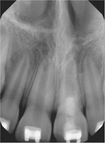 Figure 12. Periapical radiograph at 14 months postoperative showing cessation of the resorption process and apical root closure and root development.