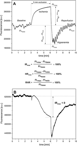 Figure 1 Definition of the IRmax, HRmax, and RHR parameters (A). An exemplary FMSF trace with a negative ischemic response (IRmax < 0) recorded for a cardiac patient (male, 71 y, ischemic heart disease, hypertension) (B).