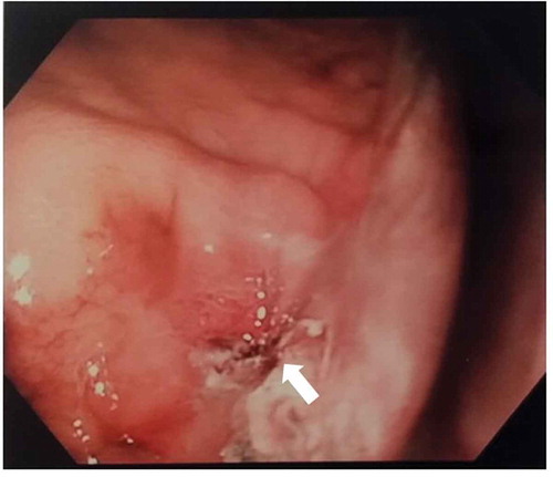 Figure 2. Gastric wall defect 6 hours after inadvertent removal of PEG tube (white arrow). Note partial sealing of the defect.