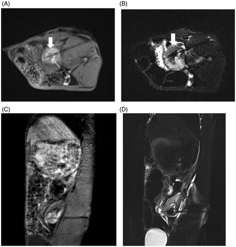 Figure 8. Immediate efficacy of postoperative MR-guided MWA. (A). 3D-VIBE-T1WI sequence typically indicated a “target sign.” Notably, the original tumor in the center of the ablation zone showed low signal intensity (thin arrow), and a high signal intensity completely surrounded the primary tumor with a clear boundary in the ablation zone (thick arrow). (B) On FS-TSE-T2WI, the signal intensity of the primary tumor was lower than that before (thin arrow), while the lesion with an unclear boundary was completely covered with a low signal intensity in the ablation zone (thick arrow). 3D-VIBE-T1WI (C) and FS-TSE-T2WI (D) oblique-coronal scans clearly revealed the location of the ablation zone.