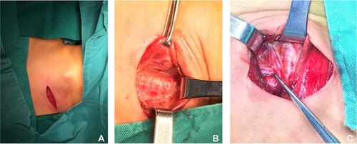 Figure 1 Lateral cervical small incision approach (A). Skin incision (B). Exposure of the superior pole of the thyroid (C). Exposure of external branch of superior laryngeal nerve.