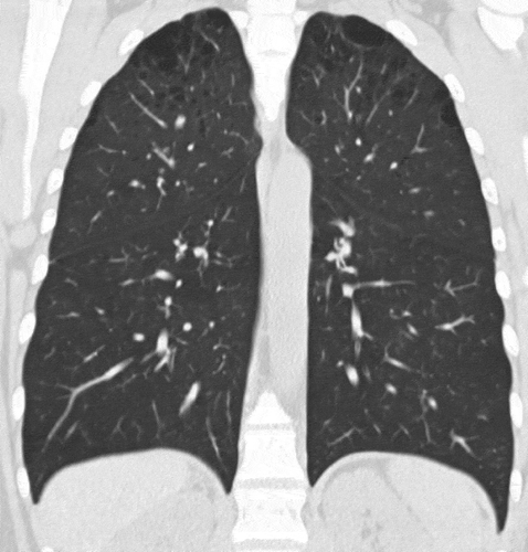 Figure 4. CT scan with bilateral centrilobular emphysema.