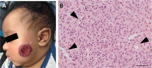 Figure 1 (A) A proliferating IH on the cheek of an infant. Note the ulceration in the center of the IH. (B) A proliferating IH is highly cellular with poorly defined vascular spaces (black arrowheads).