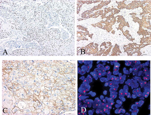 Figure 3. Immunohistochemistry and Fish detection of case 1. (a) Diffuse, positive expression of P63; (b) Diffuse, positive expression of CK5/6; (c) HER2 immunohistochemical staining showed that the tumor cells were continuously point positive in cell membrane with a score of 2+ (IHC with SP method×400) (d) FISH detection of HER2 gene amplification showed that red HER2 signals were linked into clusters