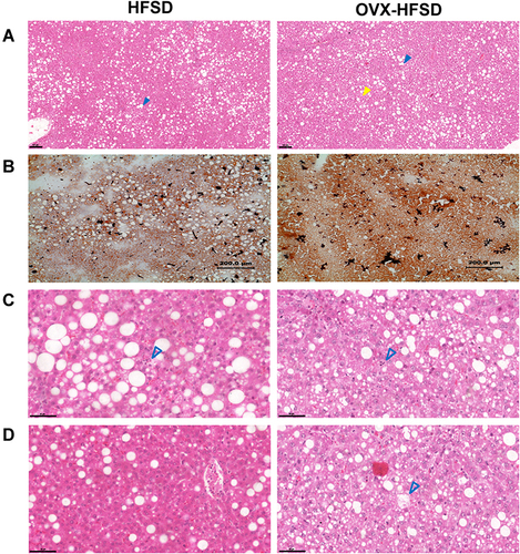 Figure 4 Hepatic steatosis (H&E stained) (A), lipid accumulation (Oil Red O stained) (B), lobular infiltrates (C), hepatocytes ballooning (D) in H&E stained liver of high fat style diet (HFSD)-fed rats, with and without ovariectomy (OVX) (n = at least 4 per group). Magnification: 8× (A), 10× (B). Yellow color closed arrow indicates microvesicular steatosis and blue color closed arrow indicates macrovesicular steatosis.