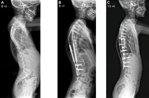 Figure 4 Lateral x-rays of the spine in patient 2 before MAGEC placement (A) and during the period of growing rod lengthening (B). Lateral radiograph after the posterior spinal fusion (C) shows proximal junctional kyphosis producing positive global sagittal balance for the spine which has to be kept under monitoring during the period of remaining spinal growth.