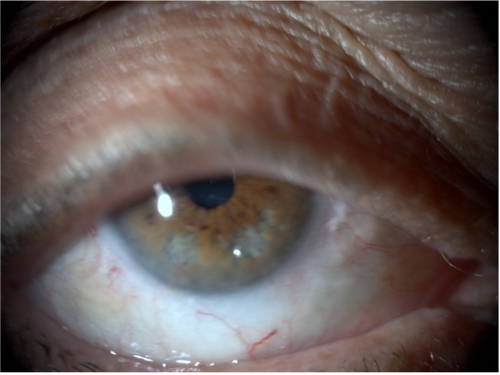 Figure 2 Right eye, reveals similar features with a shallow anterior chamber and iridoschisis concerning the inferior half of the tissue.