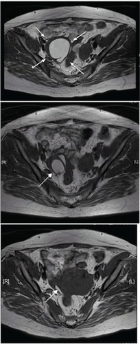 Figure 1 Magnetic resonance imaging showing changes after the administration of dienogest. Upper image, in January 2009; middle image, in April 2010; lower image, in June 2011. The size of the endometriotic cyst markedly decreased from 45 mm × 40 mm before treatment to 27 mm × 20 mm in April 2010 and to 24 mm × 5 mm in June 2011.