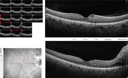 Figure 1 Optical coherence tomography scans depicting different distribution of intraretinal fluid in an eye with acute anterior ischemic optic neuropathy. A horizontal macular radial scan (lower B-scan) shows peripapillary accumulation of fluid within the outer and inner nuclear layers and a swollen optic disc. An oblique macular radial scan (upper B-scan) shows cystic cavities within the ganglion cell layer in the upper nasal parafovea.