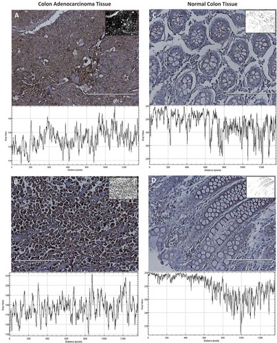Figure 8. Evaluation of HPRT expression within patient tissue. All tissues were stained with a monoclonal anti-HPRT antibody. The resulting converted grayscale image is pictured in the top left corner of each image while the grayscale plot is below. A, Tissue from a 79-year-old female patient with stage IIB colon adenocarcinoma and B, tissue from a 48-year-old female patient with stage IV colon adenocarcinoma. These malignant tissues are significantly darker stained than normal colon tissue. C, Normal colon tissue from a 36-year-old male patient and D, tissue from a 31-year-old male patient. These tissues show an upregulation of HPRT within malignant cells.