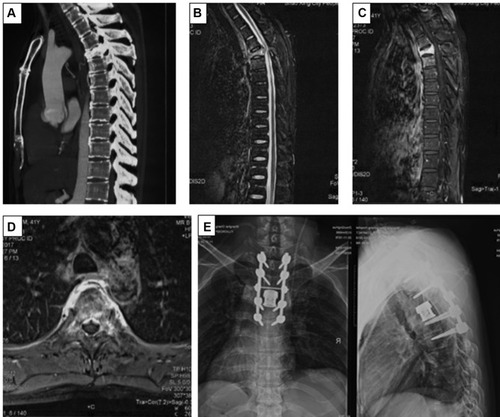 Figure 2 An illustrated SMNPC of total en bloc spondylectomy. (A) CT revealed compressed fracture at T4; (B–D) spinal cord compression and compressed T4 vertebra could be observed on MRI; (E) postoperative X-ray revealed total en bloc spondylectomy of T4 NPC and reconstruction.Abbreviations: SMNPC, spinal metastases of nasopharyngeal carcinoma; CT, computed tomography; MRI, magnetic resonance imaging.