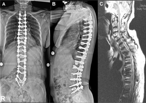 Figure 4 (A and B) The final whole spine radiographs; (C) magnetic resonance image showing fracture subluxation of T1 with proximal junctional angle of 28° (C7-T2) and severe cord compression 5 weeks after previous surgery.