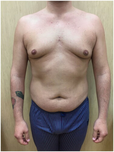 Figure 1. Preoperative photo showing grade II gynecomastia.