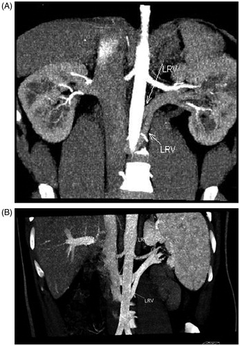Figure 3. MDCT angiogram in 25-year- old male renal donor with two retroaortic left renal vein. Oblique coronal maximum intensity projection of early arterial (A) and venous (B) phase images show two retroaortic left renal veins (arrows).