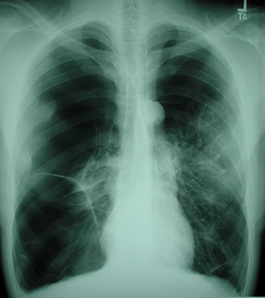 Figure 2 Chest radiograph from person with HIV and COPD demonstrating hyperinflation, flattened diaphragms, and bilateral bullous lung disease (Courtesy of Laurence Huang, MD).