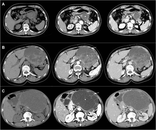 Figure 1 Characteristic pre-operative images of undifferentiated carcinoma of pancreas with osteoclast-like giant cells. (A) Female, 77-year-old (B) female, 70-year-old (C). Male, 72-year-old, intraoperative colon invasion. White triangle marks the cystic and solid lesion. White solid arrow marks the thick, contrast-enhanced wall with smooth edges.