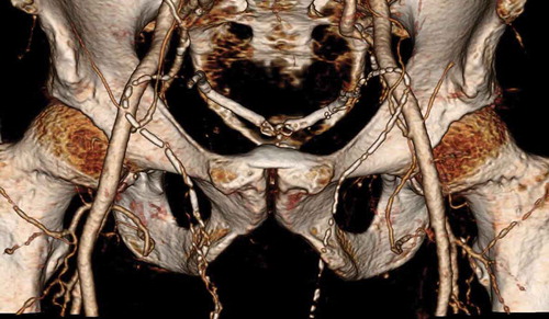 Figure 2. 3D CT reconstruction image of pelvis showing bilateral calcification of the vas deferens