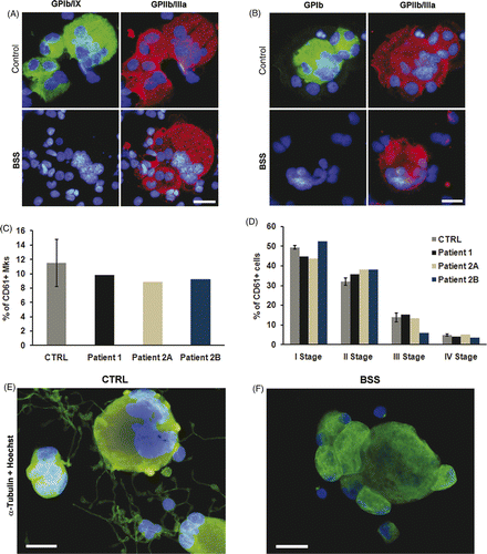 Figure 1. Analysis of megakaryocytes. Immunofluorescence analysis failed to identify GPIbα (A) and GPIb/IX (B) complex on the membrane of Mks derived from peripheral blood of BSS patients. Patient's and control's Mks were stained with anti-CD61 (red) and anti-GPIbα or GPIb/IX complex (green) antibodies. The GP defect did not affect either Mk differentiation from hemopoietic progenitors (C) or their maturation (D) with respect to relative controls (E–F). Representative immunofluorescence images of control Mks and patient derived Mks stained with anti-α tubulin antibody (green). Nuclei were always counterstained with Hoechst 33288 (blue) (scale bars, 20 µm).