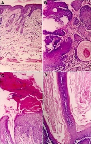 Figure 8 Photomicrographs of hematoxylin/eosin-stained sections, showing: (A) normal smooth skin of healthy animals with keratinocytes of only a few cell layers thick, mild keratin, and pilosebaceous units; (B) the positive control (DMBA treated animals followed by no POH treatment) has profuse papillomatous growth with complex fibrovascular core, prominent acanthosis, and keratin perl; (C) treatment with free form of POH resulted in large amount of keratin, and marked acanthosis; while (D) the treatment with PLGA microsphere encapsulated POH resulted in hyperkeratosis, mild acanthosis, and thin but long papillary growth.Note: Magnification 100×.