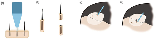 Figure 1 Schematic drawing illustrating transversely sectioned mini-punch grafting. (a) Mini-punch grafts extracted from donor sites similar to follicular unit extraction. (b) The grafts transversely sectioned. (c) The intact half follicles placed in the recipient sites of the hairy areas within the hairline. (d) The sectioned mini-punch grafts with the half hair follicles removed to place in the recipient sites of the forehead outside the hairline.