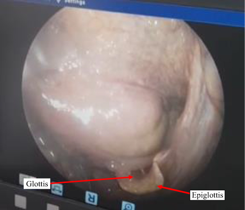 Figure 2 Rigid bronchoscopy of the patient showing nearly closed glottis before intubation.