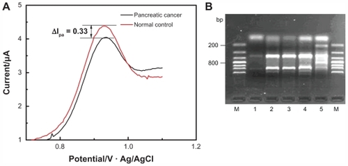 Figure 3 Diagrams of differential oxidation current between pancreatic cancer patient and normal control (A) and the gel electrophoresis of polymerase chain reaction product (B) on multiwalled nanotube-modified glassy carbon electrode.