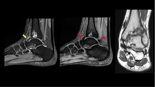 Figure 2 MRI of the ankle joint: sagittal T2WI, sagittal gradient sequence and coronal PDWI, show intra-articular synovial low signal intensity (yellow arrow) demonstrating blooming artifact on the gradient sequence (red arrows) in the anterior and posterior recess of the ankle joint consistent with blood degradation products related to repeated episodes of hemarthrosis. Again, secondary osteoarthritic changes are noted with multiple cystic changes/geodes with surrounding marrow oedema. Findings are consistent with siderotic chronic synovitis.