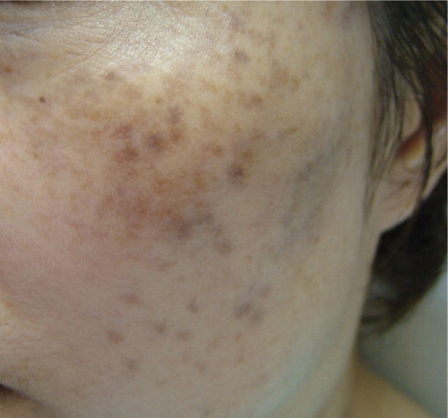 Figure 2 After seven sessions with iontophoresis vitamin C.