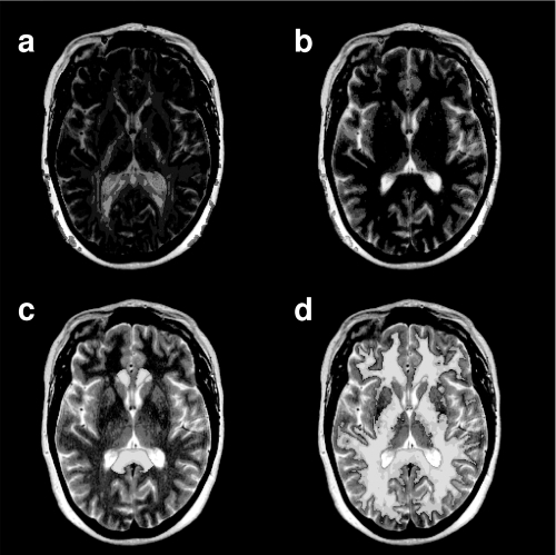 Figure 1 An axial slice from the T2-weighted (T2W) image of a representative individual. The slice position was chosen to cut through both the trigone of the lateral ventricles and the genu and splenium of the corpus callosum (CC). The T2W image shown has been co-registered to native “DTI-data” space. (a) The T2W image with FA data superimposed in color. (b) The T2W image with the apparent diffusion coefficient image superimposed in color. The T2W image and the ADC map were chosen as the image pair to perform the co-registration procedure. (c)The T2W image with the CC ROI superimposed in color. Note that there is no overlap between the ROI and the CSF (bright in the T2W image). (d) The T2W image with the WM map generated from the T1-weighted data superimposed.