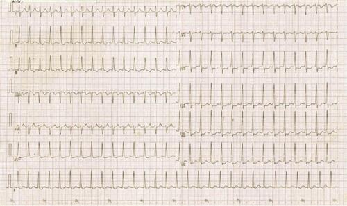 Figure 2 EKG showing supraventricular tachycardia.