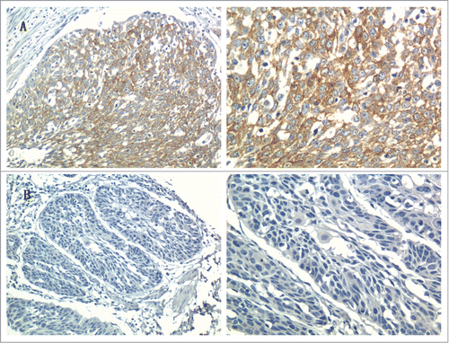 Figure 1. Representative immunostaining of RACK1 in ESCC tissues (Left, × 200; right, × 400): (A) ESCC tissue with positive expression; (B) ESCC tissue with negative expression.