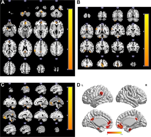 Figure 2 Brain regions of DMN that had significantly different FC values among the four groups.