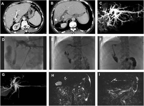 Figure 4 Male, 51 years old with chronic hepatitis B related cirrhosis, performed resection of right liver lobe (the 1th patient). (A) One month after surgery, abdominal enhanced-CT appeared left liver lobe compensatory hypertrophy. (B) Three months after TACE operation, upper abdominal enhanced-CT showed that the original operation of lipiodol deposition, the left intrahepatic bile duct dilatation. (C and D) Four months after TACE, MRCP showed the left intrahepatic bile duct dilatation obviously; PTCD showed left intrahepatic bile duct dilatation and hilar bile duct stricture obviously, performed Balloon dilatation and liver external biliary drainage. (E and F) Ten months after TACE, due to obstructive jaundice hospitalized again, cholangiography displayed hilar bile duct line-like structure and left intrahepatic bile duct stick-like change; performed biliary stent implantation and postoperative imaging showed bile duct patency. (G-I) Three months after biliary stent implantation, MRCP displayed left intrahepatic bile duct atrophy changes, multiple gallstone (arrow) and the left intrahepatic bile duct stones (arrow), however these changes did not appear before TACE.
