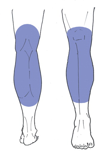 Figure 2. Schematic diagram showing the area that can be covered with proximally based sural artery flap. The colored area represents the area from the prepatellar and popliteal areas to the middle of the lower leg.