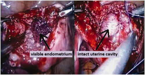 Figure 1. On the left – intrauterine breach during myomectomy with endometrial tissue visible on the bottom of the fibroid bed. On the right – myomectomy without opening of the uterine cavity during the enucleation of leiomyoma.