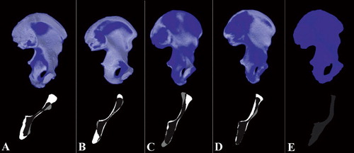 Figure 5.  Five examples of overlay volumes from a poor recipient/allograft match (categorized as unacceptable) (A) to a good match (categorized as adequate) (D). Panel E shows a perfect match of the recipient with the trap (after alignment by registration). The top represents a 3-D view of the overlay volume with 2 colors: recipient in light blue, and graft in darker blue. [Authors: OK?] The bottom shows slices extracted from the same overlay volume at the level of the sacroiliac joint. Panel E shows the perfect alignment achieved by the registration method. On the corresponding 2-D slice, only 3 voxels were not overlapping. This is the systematic error produced by the registration method.