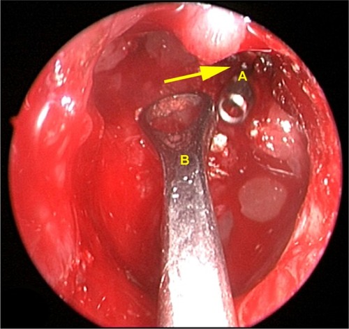Figure 6 FS surgery through a combined intra–extranasal approach.