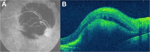 Figure 60 (A) Fluorescein angiography shows leakage from the aneurysm and surrounding area that is blocked by preretinal and retinal hemorrhage. (B) Spectral-domain Cirrus™ optical coherence tomography showing an active retinal arterial macroaneurysm.