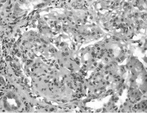 Figure 2.PAS staning demonstrated tuft lobulation and mesangial hypercellularity. This appearance is very characteristic of membranoproliferative GN.