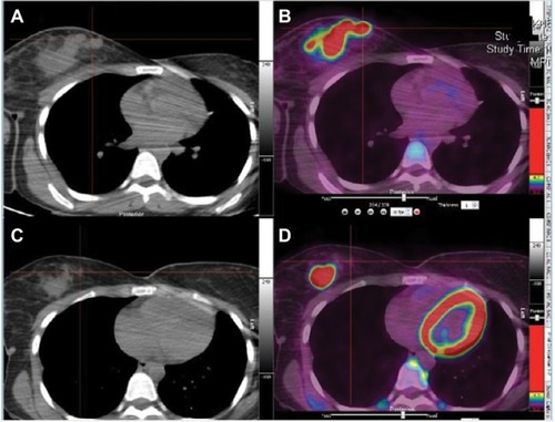 Figure 1 Pre-neoadjuvant chemotherapy PET-CT (C, D) and post-neoadjuvant chemotherapy PET-CT (A, B) in case 3 revealing right large mass with progression after neoadjuvant chemotherapy.