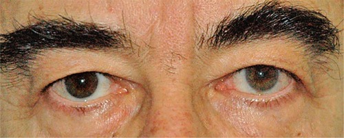 Figure 4 Heterochromia due to unilateral therapy with travoprost in right eye.