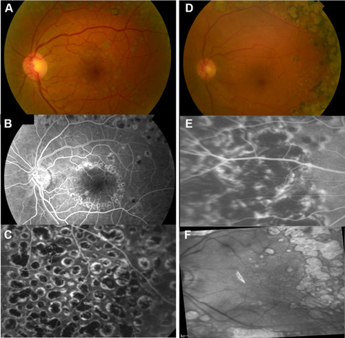 Figure 1 Examples of treatment patterns. (A–C) patient 1; (D) and (E) patient 2; (F) patient 3. (A) Fundus photography; (B) macular temporal horseshoe, fluorescein angiography; (C) confluent PRP pattern, fluorescein angiography; (D) fundus photography; (E) very confluent PRP pattern, fluorescein angiography; (F) macular focal treatment, fluorescein angiography.