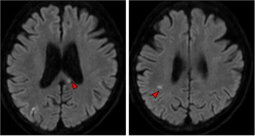 Figure 2. Magnetic resonance images showing multiple brain infarctions (Trousseau's syndrome).The red arrows indicate the metastatic areas.