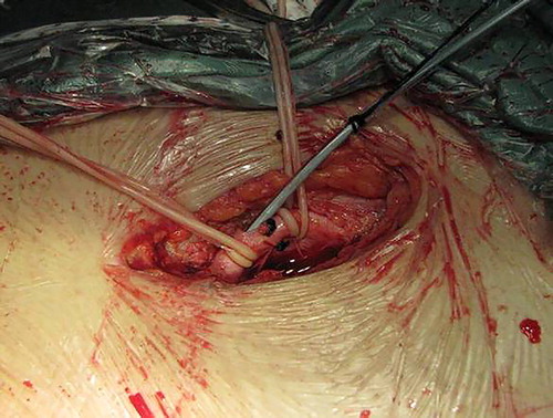 Figure 2 Exposing the femoral artery and inserting a Fogarty catheter into it.