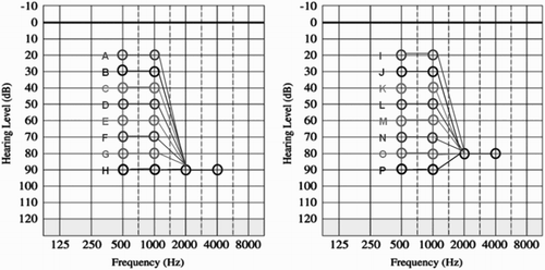 Figure 1 Hearing loss configurations and corresponding SII values. Configurations A to H are in line with current 90 dB HL audiometric candidacy. Configurations I to P represent the proposed 80 dB HL criteria.