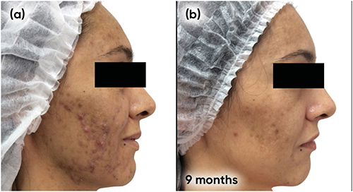 Figure 5 Case study 3 improvement on both sides of face, baseline to 9 months. (a) Baseline (b) 9 months with spironolactone 50mg twice a day plus AZA 15% gel twice a day.