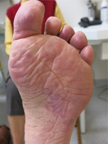 Figure 1 Palmar erythema with slight edema. Toes are involved as well.