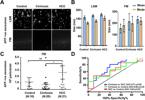 Figure 7 Quantification of AFP+ve HCC exosomes using fluorescent-nanoparticle tracking analysis (F-NTA). Ten microliters of serum samples were diluted in 100μL of PBS with 1% BSA. AFP antibody (1:100) incubation was performed at 4°C overnight. The next day samples were diluted in 1mL of ultrapure water and passed through a gel-filtration column. Samples were further diluted (1:10) in 1 mL water and analyzed by NTA. (A). Representative video image of extracellular vesicles (EVs) analysis captured in light scattered mode (LSM) and fluorescence mode (FM) of immunocaptured using PE-conjugated AFP antibody. (B). Show the size (mean and mode) measured in LSM and FM. (C). Particle size distribution of EVs analyzed in LSM and FM. Quantification of immunocaptured EVs using AFP antibody in normal, cirrhosis and HCC serum detected using FM. The particle number obtained in FM mode was normalized with the particle number obtained in LSM for each sample. Statistical significance levels were presented as ns for non-significant, * for p<0.05 (D). ROC analysis shows the sensitivity and specificity values of AFP vesicles in normal, cirrhosis, and HCC.