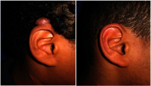 Figure 2 Auricular keloid. Before and after treatment result at 2-year follow-up.